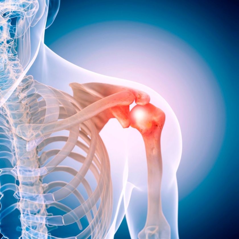 Physical Therapy For Shoulder Pain In New York City Shoulder Sprains